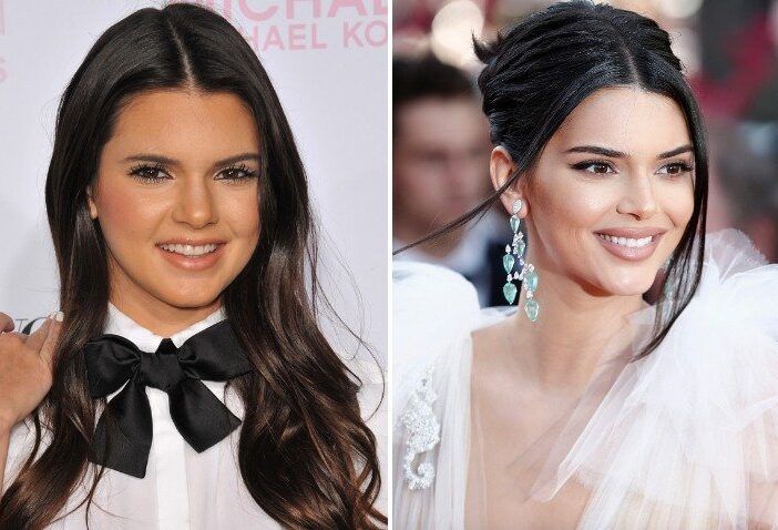 ¿Kendall Jenner se hizo cirugía plástica? Cómo se ha transformado su rostro a lo largo de los años